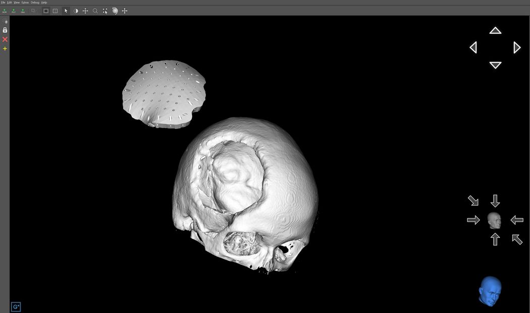 Screenshot aus der App (WHZ-WIW) mit einem 3D-Implantatmodell, welches von Herrn Patrick Knorr (WHZ-AMB) konstruiert wurde.